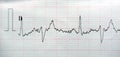 ECG ElectroCardioGraph paper that shows Normal Sinus Rhythm NSR with frequent PACs Premature Atrial Contractions, PVCs Premature