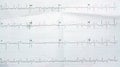 ECG ElectroCardioGraph paper that shows Normal Sinus Rhythm NSR with frequent PACs Premature Atrial Contractions, PVCs Premature