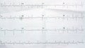 ECG ElectroCardioGraph paper that shows Normal Sinus Rhythm NSR with frequent PACs Premature Atrial Contractions, PVCs Premature Royalty Free Stock Photo