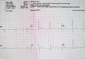 ECG ElectroCardioGraph paper that shows sinus rhythm abnormality of right ventricular hypertrophy, inferior T wave due to