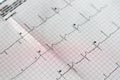 ECG ElectroCardioGraph paper that shows sinus rhythm abnormality of right ventricular hypertrophy, inferior T wave due to