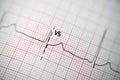 ECG ElectroCardioGraph paper that shows sinus rhythm abnormality of right ventricular hypertrophy, inferior T wave due to