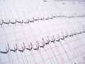 ECG electrocardiography