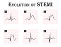 ECG of evolution ( step by step ) of STEMI Royalty Free Stock Photo