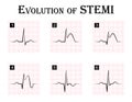 ECG of evolution ( step by step ) of STEMI