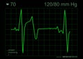 ECG graph