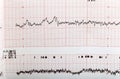 Ecg graph Royalty Free Stock Photo