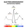 ECG of a heart in normal sinus rhythm Royalty Free Stock Photo