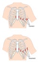 Ecg lead placement Royalty Free Stock Photo