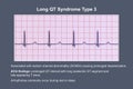 ECG in long QT syndrome type 3, 3D illustration, annotated Royalty Free Stock Photo