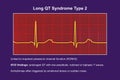 ECG in long QT syndrome type 2, 3D illustration, annotated Royalty Free Stock Photo