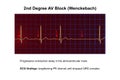 ECG of 2nd degree AV block Wenckebach , 3D illustration