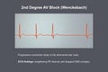 ECG of 2nd degree AV block Wenckebach , 3D illustration