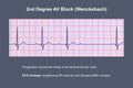 ECG of 2nd degree AV block Wenckebach , 3D illustration