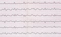 ECG with paroxysm correct form of atrial flutter with atrioventricular conduction 2:1 Royalty Free Stock Photo