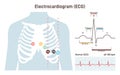 ECG procedure. Cardiovascular checkup with cardiogram. Heart disease