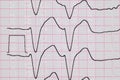 ECG with rhythm disturbance, ventricular extrasystole close-up. Premature contraction of the ventricles