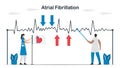 ECG signal of atrial fibrillation. Doctors check and analyze a heart disease. Cardiology vector illustration Royalty Free Stock Photo