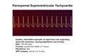 ECG in supraventricular tachycardia, 3D illustration