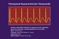 ECG in supraventricular tachycardia, 3D illustration