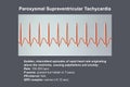 ECG in supraventricular tachycardia, 3D illustration