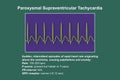 ECG in supraventricular tachycardia, 3D illustration