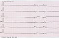 ECG tape (dying heart)