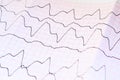 ECG tape with paroxysmal ventricular tachycardia