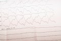 ECG tape with paroxysmal ventricular tachycardia and ventricular Royalty Free Stock Photo