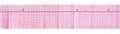 ECG tape with stop of sinus node and replacement complex from atrioventricular junction