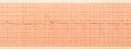 ECG test results on millimeter paper, heart rhythm results Royalty Free Stock Photo