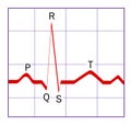 ECG trace