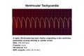 ECG in ventricular tachycardia, 3D illustration.