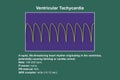 ECG in ventricular tachycardia, 3D illustration.