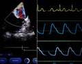 Echocardiographic parameters synchronized with ECG. Screen of a Royalty Free Stock Photo