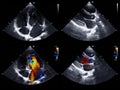 Echocardiography