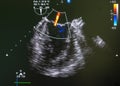 Echocardiography ultrasound machine. Mitral valve regurgitation jet