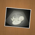 Echography of baby