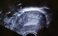 Ecography ultrasound endometrial layer