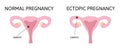 Ectopic and normal pregnancy. The fertilized egg, uterus, womb