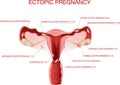 Ectopic Pregnancy concept. Infographics. illustration on isolated background.