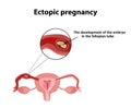 Ectopic pregnancy. The embryo in the fallopian tube. Infographics. Vector illustration on background