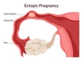 Ectopic pregnancy. Tubal pregnancy medical illustration, embryo Royalty Free Stock Photo