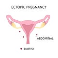 Ectopic Pregnancy. Type of extra-uterine pregnancy abdominal