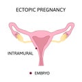 Ectopic Pregnancy. Types extra-uterine pregnancy. Intramural Royalty Free Stock Photo