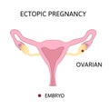 Ectopic Pregnancy. Types of extra-uterine pregnancy, ovarian