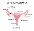 Ectopic Pregnancy. Types of Tubal pregnancy, ovarial, abdominal