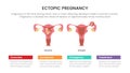 Ectopic pregnant or pregnancy infographic concept for slide presentation with 3 point list Royalty Free Stock Photo