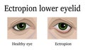 Ectropion of the lower eyelid