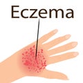 Eczema affected a hand Dermatology skin disease